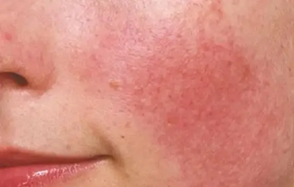 皮膚紅腫