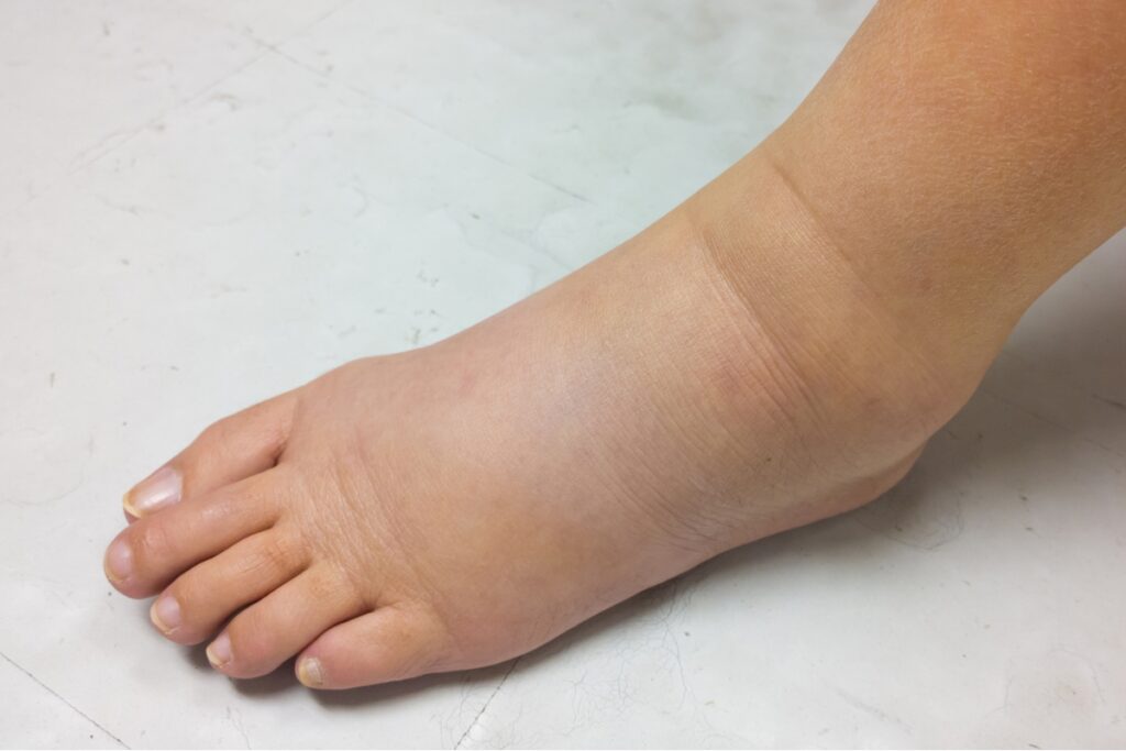 水腫是甚麼?
