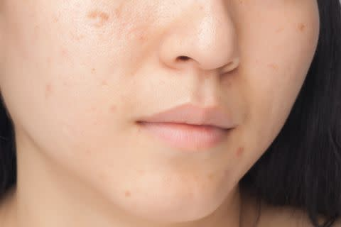 暗瘡印的種類