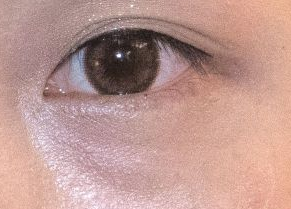 眼袋型淚溝